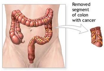 Colon with Colorectal Cancer.