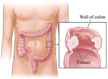 Colon Rectal Cancer: Information, Causes, Symptoms and Diagnosis.