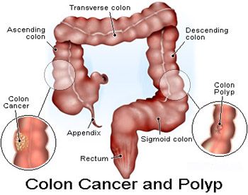 Causes, Symptoms and Treatment of Colon Polyps.